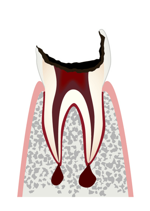 歯の上部が失われた歯